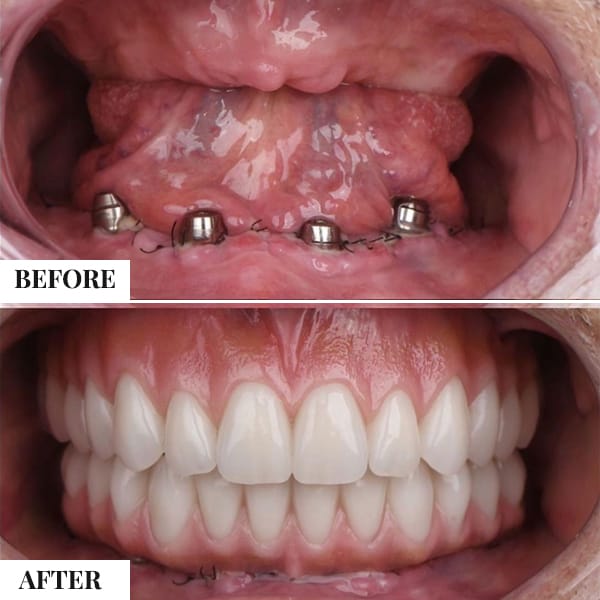 Implant Procedure 1