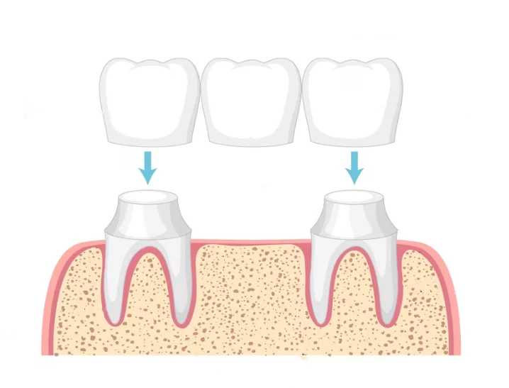 Dental Bridges