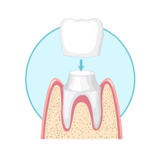 Dental Crowns